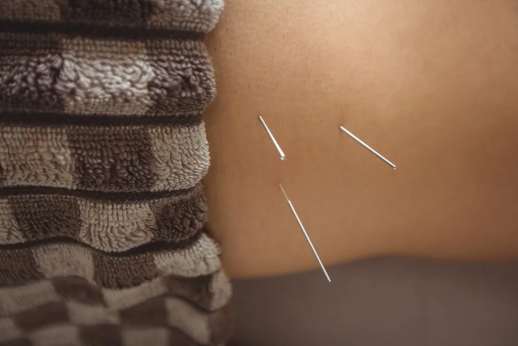 Din ce sunt făcute acele pentru acupunctură? Din ce sunt făcute acele pentru acupunctură?