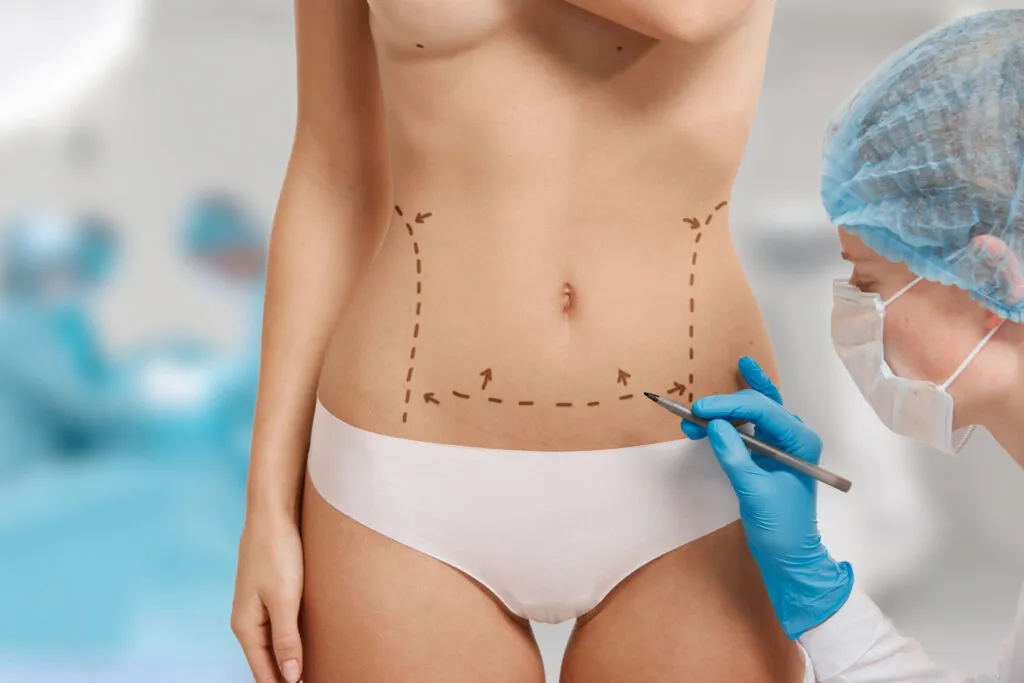 Corpul tău, regulile tale: Ghidul tău despre liposucție și abdominoplastie