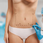 Corpul tău, regulile tale: Ghidul tău despre liposucție și abdominoplastie