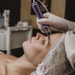 Excizia alunițelor cu laserul CO2: Cum funcționează, avantaje și ce trebuie să știi înainte de procedură